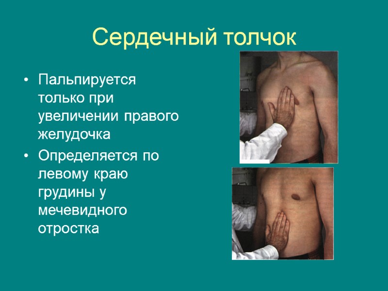 Сердечный толчок Пальпируется только при увеличении правого желудочка Определяется по левому краю грудины у